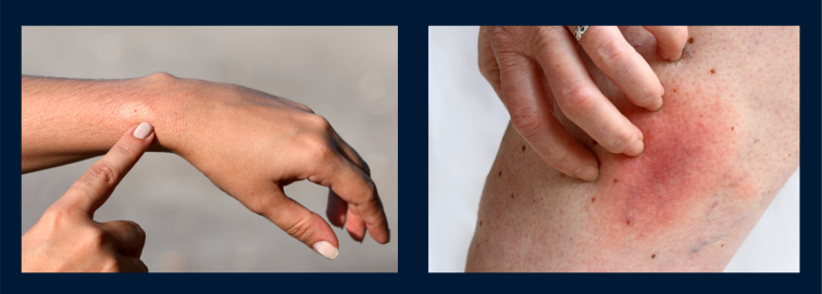 Harmless – albeit annoying – insect bites